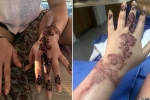 fashion and beauty, hand burnt due to henna tattoo, henna tattoo cause aussie woman to almost lose her hand, Blisters