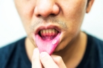 Mouth Ulcers, Mouth Ulcers advise, mouth ulcers and home remedies, Mouth ulcers