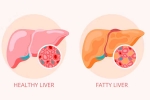 Grade 2 Fatty Liver symptoms, Grade 2 Fatty Liver news, how to reverse grade 2 fatty liver, Causing