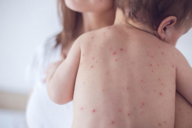 Measles Back in the United States as Children Omit Vaccination Doses Measles Back in the United States as Children Omit Vaccination Doses