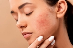 home remedies, acne, 10 ways to get rid of pimples at home, Cleaning