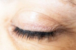 Eyelash Dandruff symptoms, Eyelash Dandruff treatment, all about eyelash dandruff, Naked