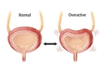 Overactive Bladder signs, Overactive Bladder latest, here are some warning signs of an overactive bladder, Overactive bladder